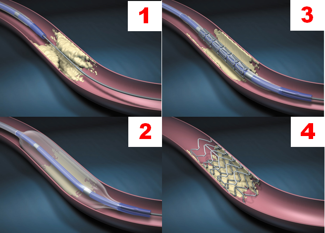 STENT